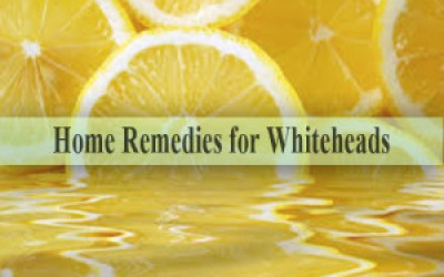 Home Remedies for Whiteheads â€“ 2